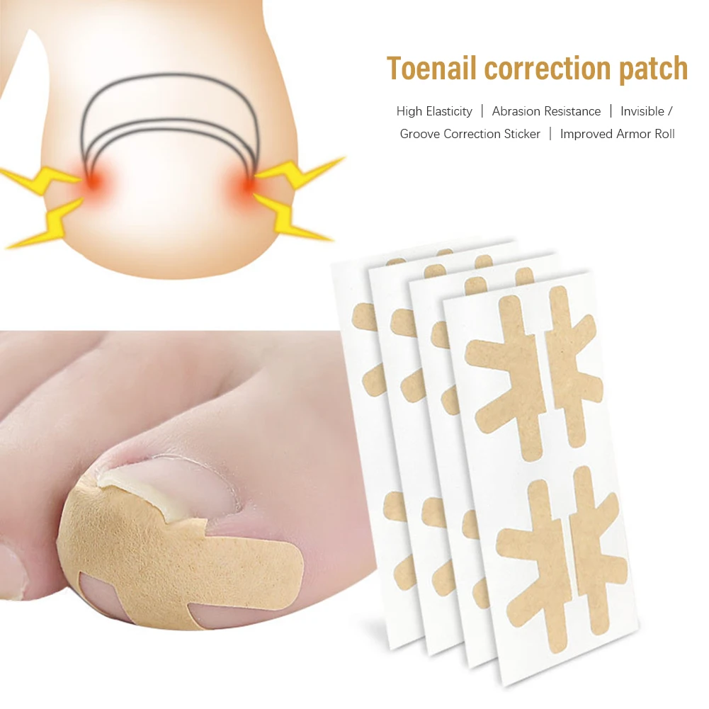 Пластыри для исправления вросших ногтей. Пластырь для ногтевой пластины. Инструмент для коррекции вросших ногтей корректор. Пластырь для ногтевой пластины. Пластырь для коррекции вросшего ногтя.