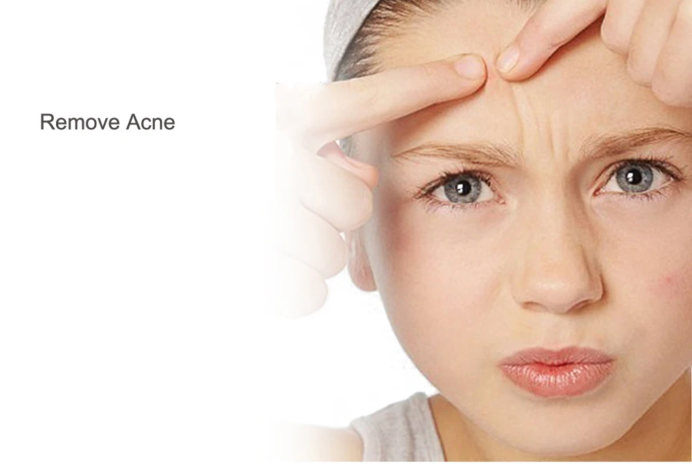 Remove Acne