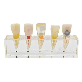 

Endodontic Pathological Anterior Front Labial Teeth Model Lab Dentistry Endo Model