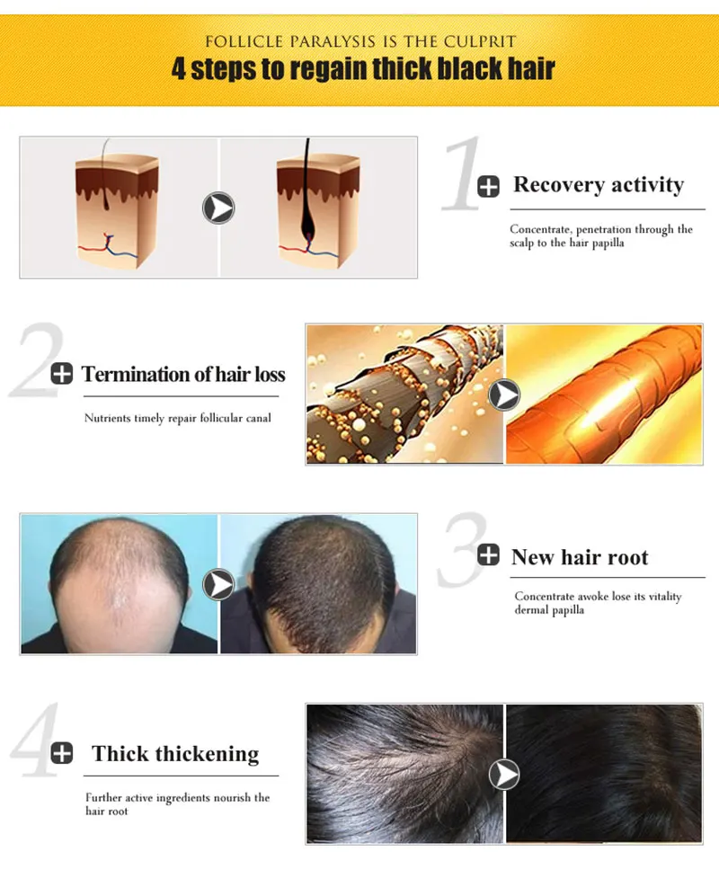 perda de alopecia gengibre líquido sunburst yuda pilatory óleo