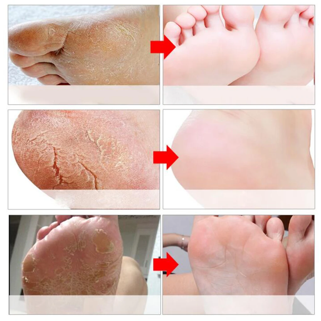 3pcs EFERO Feet Mask Peeling Dead Skin Remover Feet Mask Exfoliating Foot Mask Socks Pedicure Foot Care Detox Foot Patch
