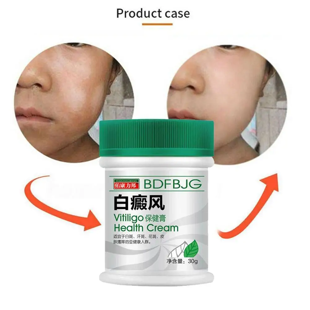 Мазь Sumifun Vitiligo китайская для дневных симптомов на руках крем спины лечение шеи и