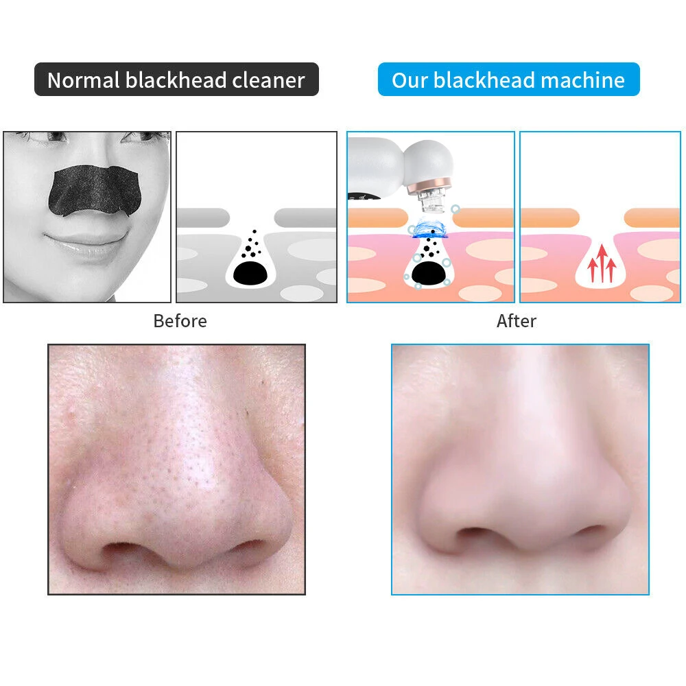 New Blackhead Remover Vacuum Suction Personal Care Small Bubble Electric Face Nose Cleaner 6