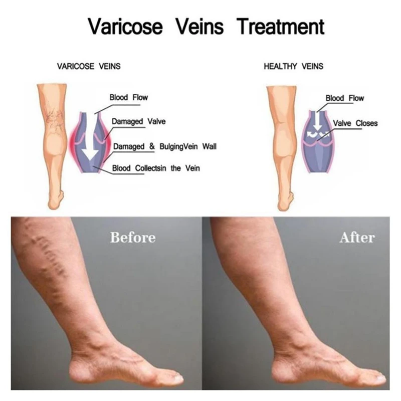 funcionarea asupra venelor varicoase ale unui mic pelvis