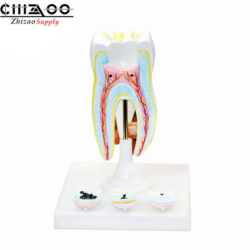 Стоматологические моляры с кариес, модель кариеса стоматологическая модель кариеса обучающая модель зубов уход за зубами образование стоматологические инструменты материал для стомато