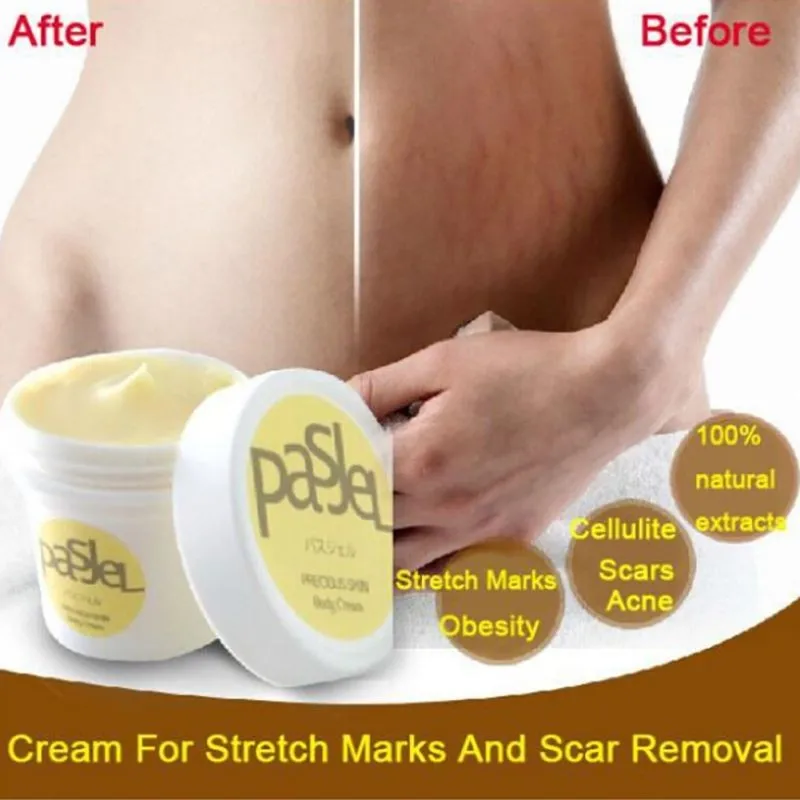body stretch mark cream