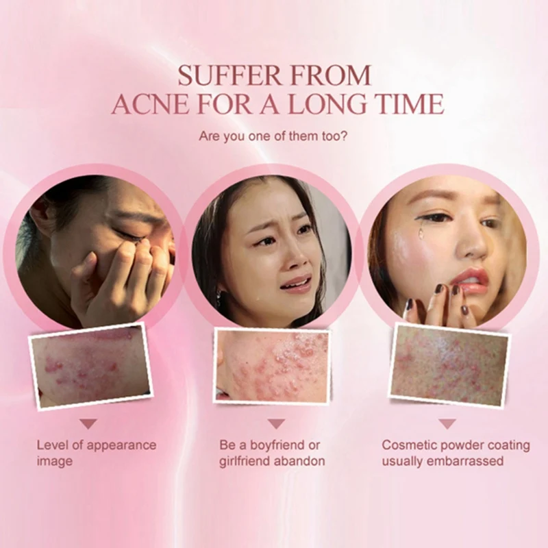 30g Acne Treatment Anti Acne Scar Removal Pimple Blackhead Moisturizing Whiten Oil control Shrink Pores Face 4