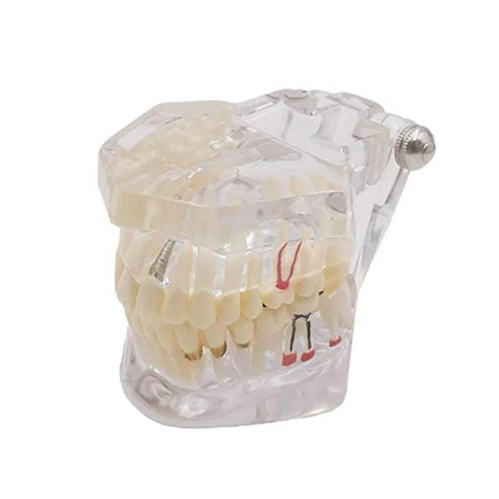 Зубной Имплантат модель зубов с восстановлением мост модель зуба для стоматологического обучения инструменты стоматологический медицинский материал