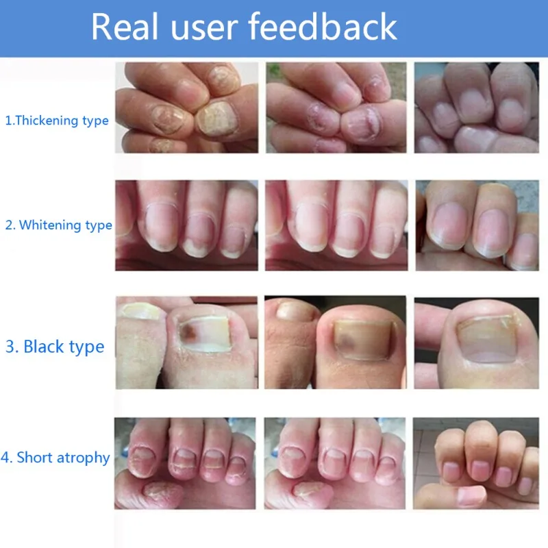 Onychomycosis Removal Liquid Remove Fungus Sterilization Nail Repair Liquid Nail Treatments 30ml