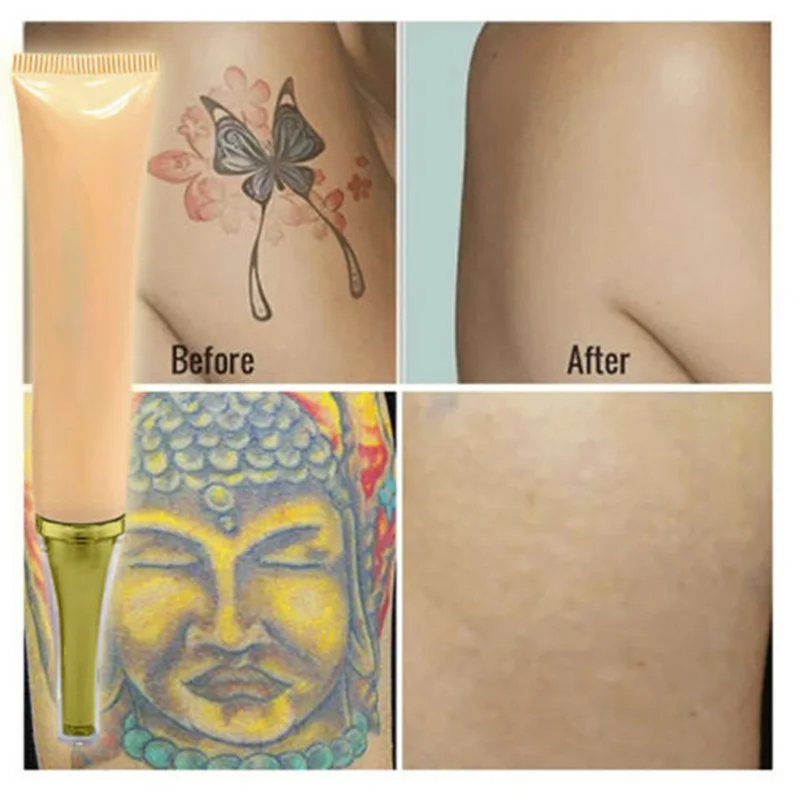 Can this cream remove your tattoo? | CNN