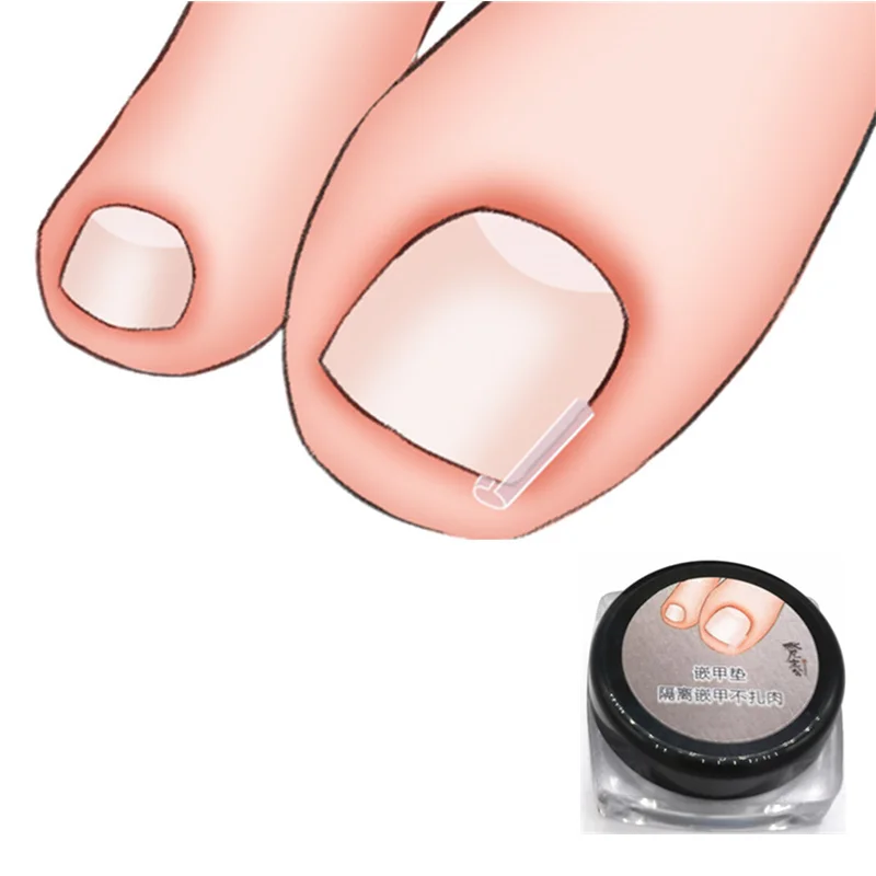 20 Piece Nail Pad Inlay Nail Infilled Pad Nail Groove Pad Onyxis