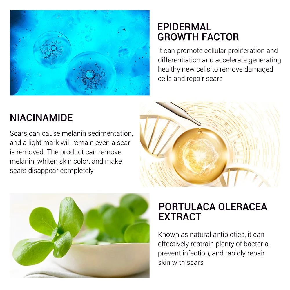 BREYLEE Acne Scar Removal Cream 30g Face Cream Skin Repair Skin Care Scar Acne Treatment Remove Stretch Marks Whitening Cream   (3)