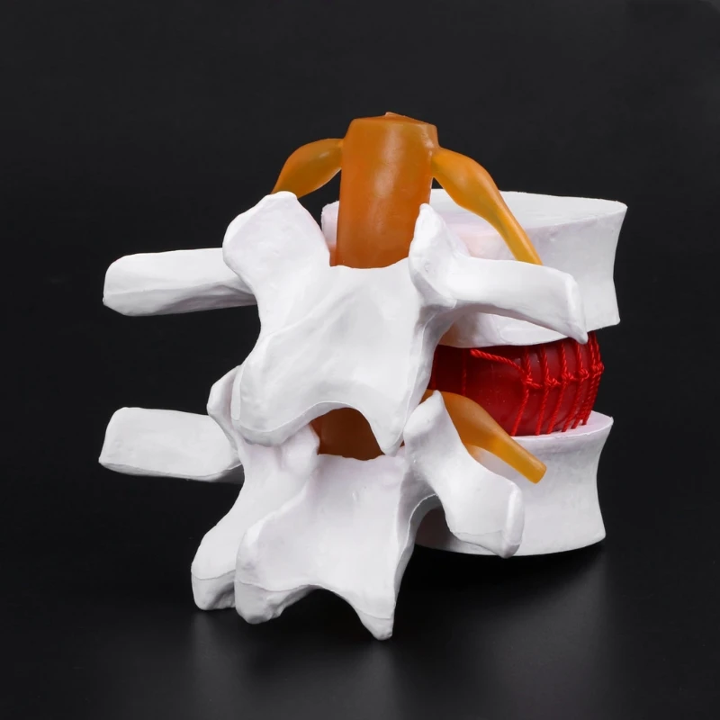 

Human Anatomical Lumbar Disc Herniation Model Medical Learn Aid Anatomy Instrume LX9A