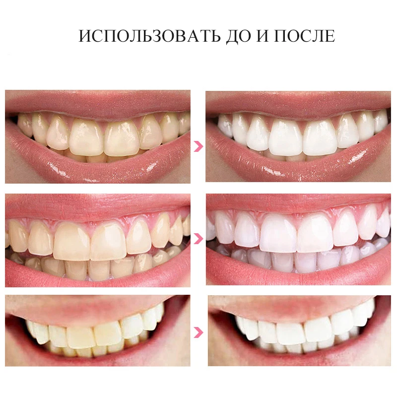 Красивые зубы. Реставрация переднего зуба. Орша беларусь стоматология. Виниры-элайнеры snap-on smile. Красивые зубы.