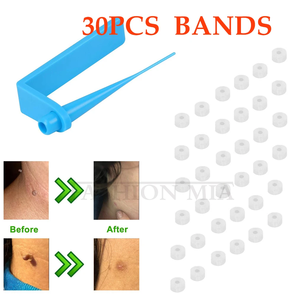 skin tag remover Rubber bands for micro Skin tag remover wart Remove
