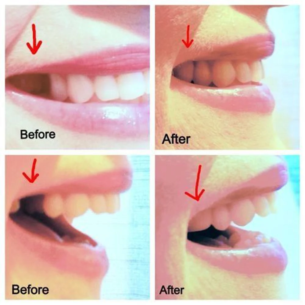Diy Missing Tooth Temporary Replacement Teeth Repair False Temp Tooth