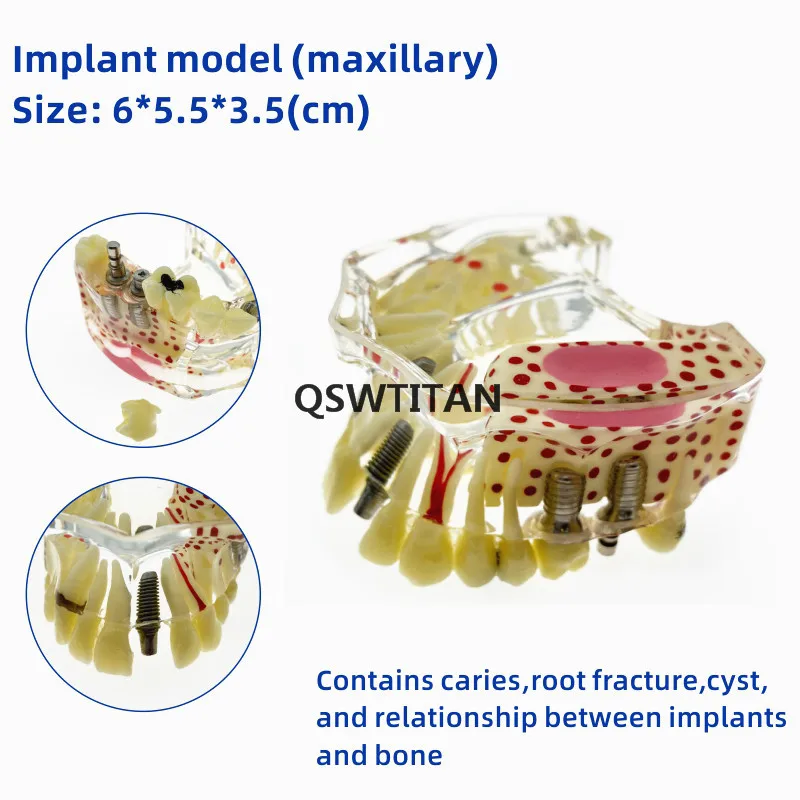 Modelo dentário com ponte e cavidades, modelo para implante dentário
