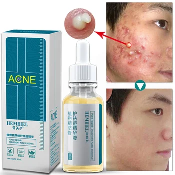

Acne Treatment Face Serum Shrink Pores Serum Moisturizing Hydrating Anti-Acne Whitening Cream