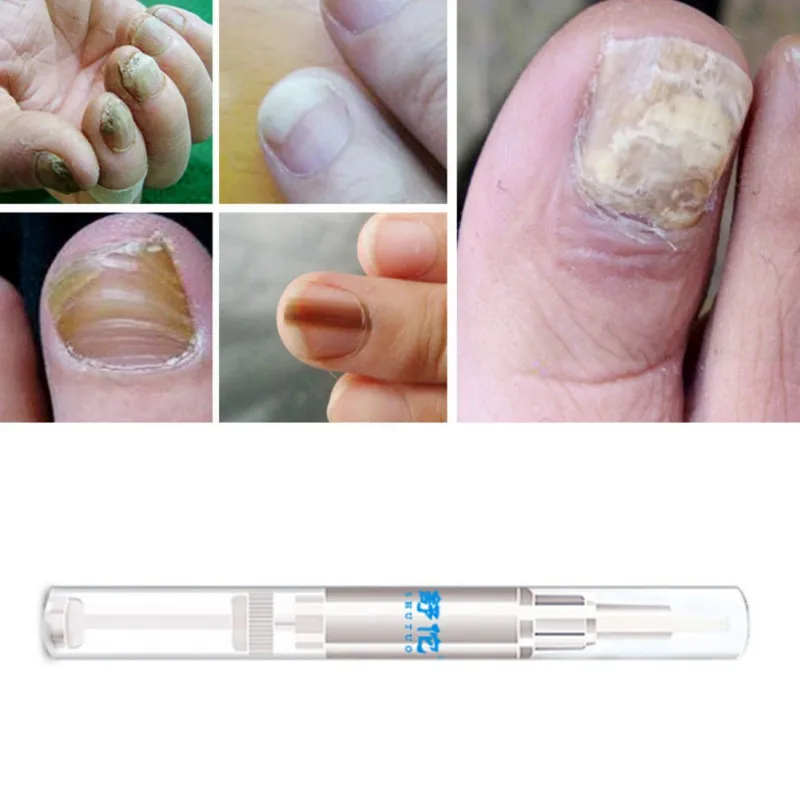 Ручка для лечения Ногтей противогрибковые Onychomycosis Paronychia хороший результат инфекция ногтей Китай травяной носок Лечение грибка