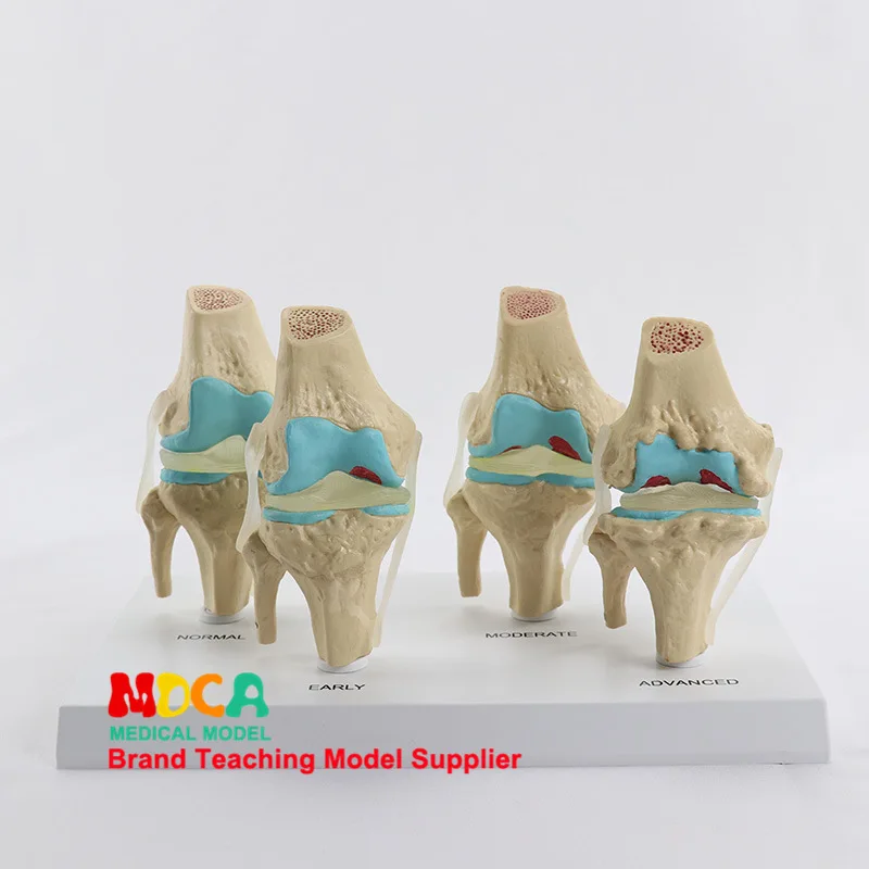 

Four Typing Knee Normal Kneecap Lesions Combination Model Skeleton Model Orthopedic Medicine Teaching Mgj007