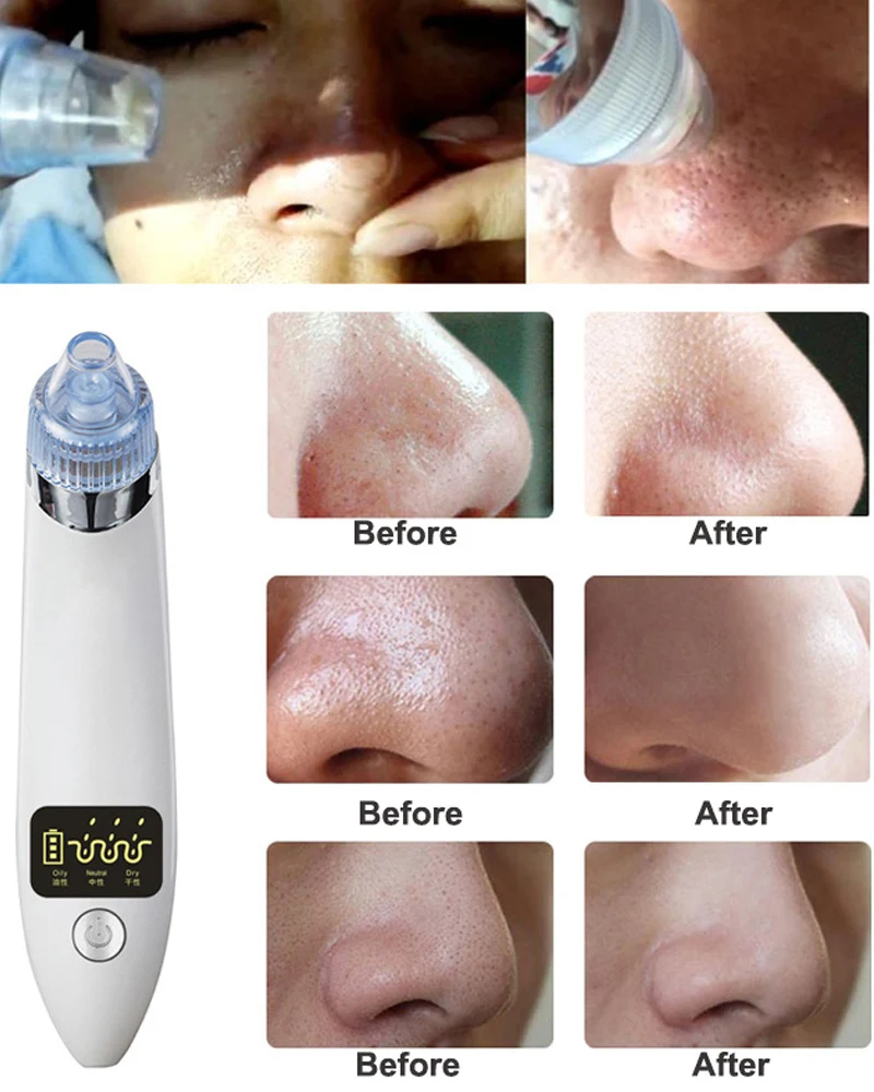 Blackhead Pore Vacuum LCD Display Electric Acne Pimple Remover Tools Vacuum Suction Black Spot Pore Cleaner Face Skin Care Tool 9