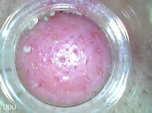 Eliminador de espinillas por calor, aspiradora de poros para nariz, cara, acné, succión, pantalla LCD recargable, herramientas de eliminación de puntos de succión