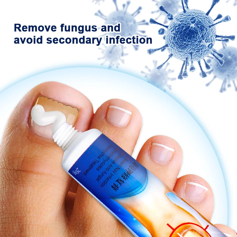 1pcs Nail Fungus Treatment Cream Onychomycosis Paronychia Herbal Antibacterial Repair Ointment Anti Fungal Feet Toe Care P1148