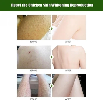 

Chicken Skin Folliculitis Treatment Exfoliating Shrink Pores Keratosis Pilar Remover Essential Oil