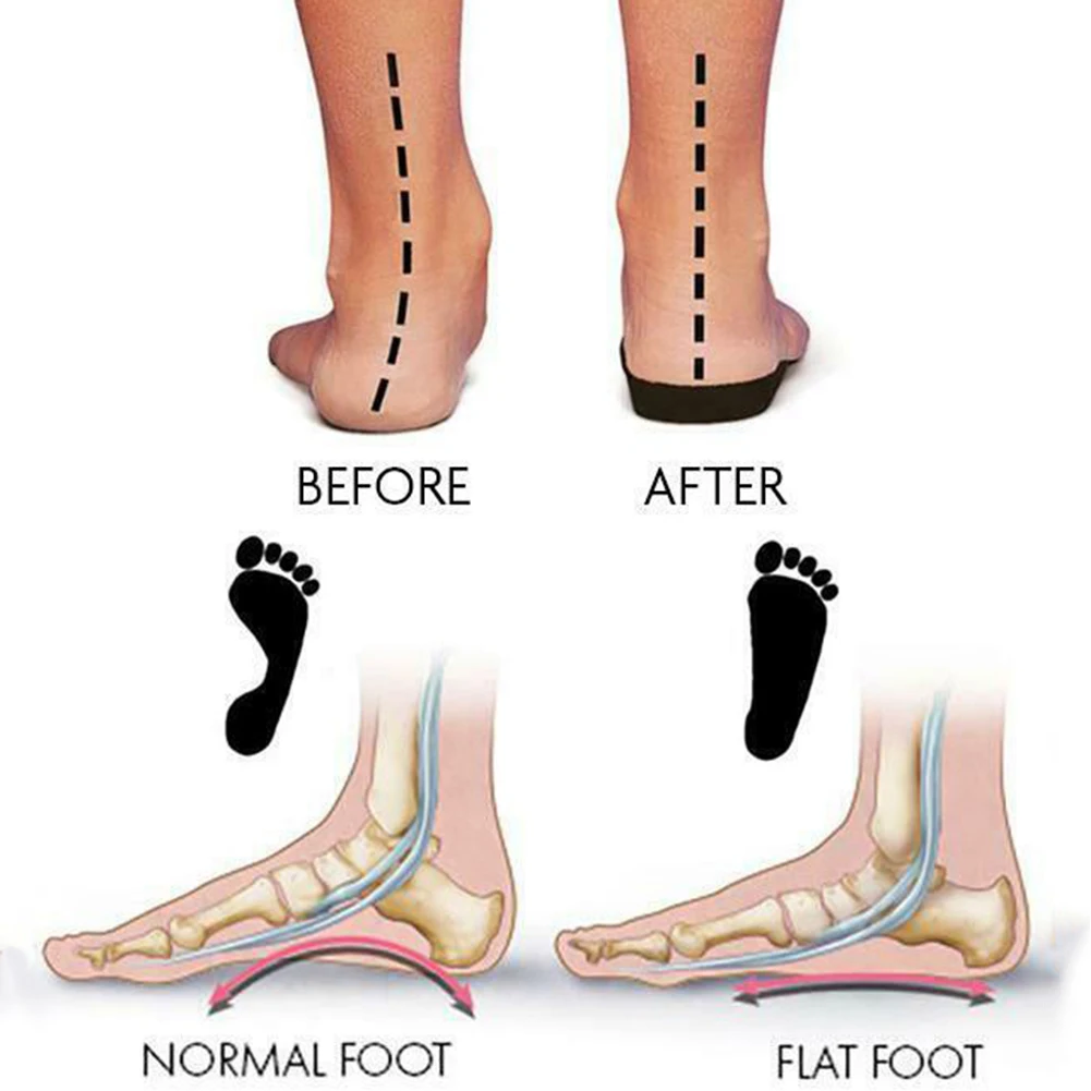 1Pair=2pcs Silicone Toe Corrector Gel Protector Unisex Feet Orthopedic Bunion Corrector Overlapping Toes Separator Protector