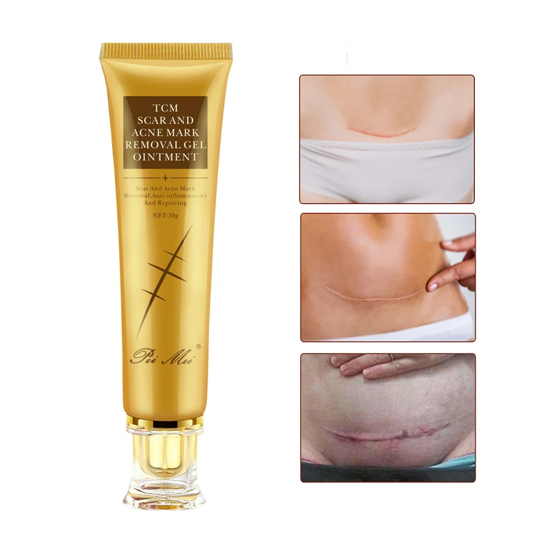 Removal Scar Cream Face Pimples Scar Stretch Marks Removal Acne