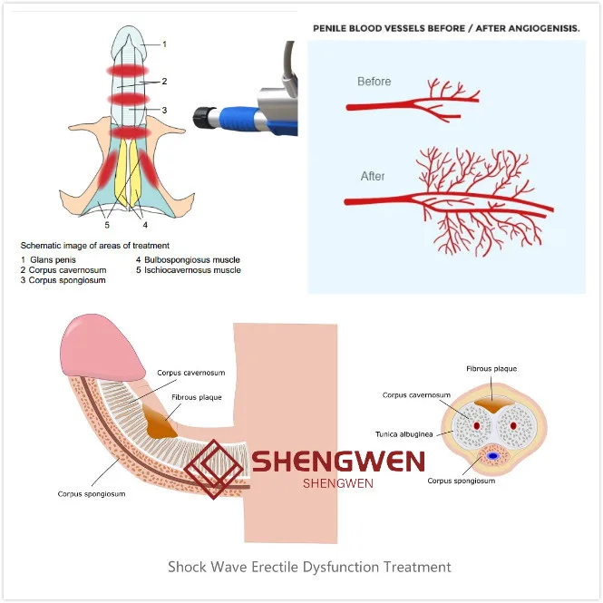あなたが勃起不全を持っているかどうかを確認するためにテストします