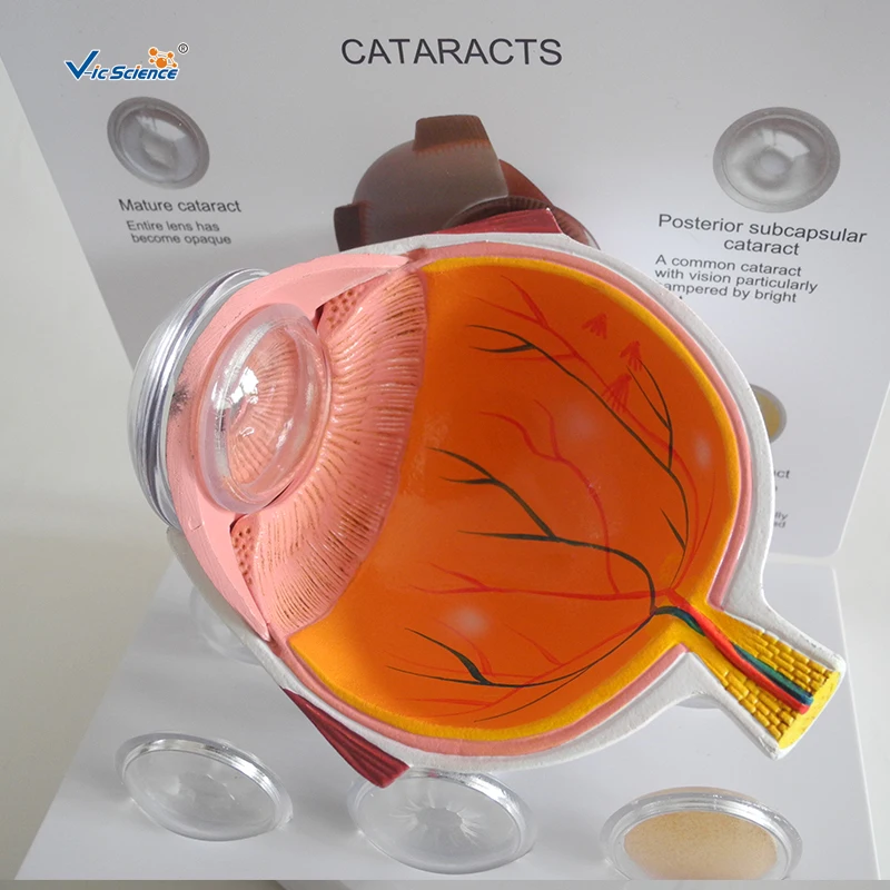 Медицинского образования до катаракты глаз анатомия модель