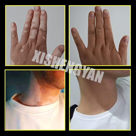 Водонепроницаемая маскирующая ручка Leukoderma Vitiligo жидкая эссенция растений для