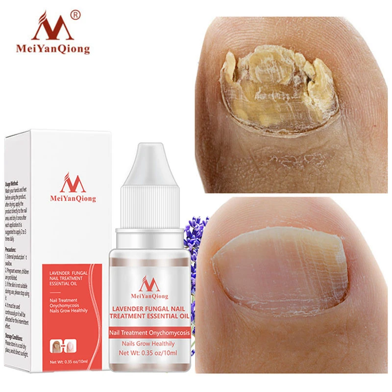 Nail Fungus Treatment Cream Onychomycosis Paronychia Anti Fungal Herbal White Blue Walmart