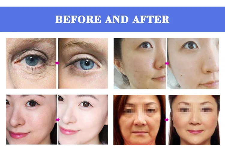 Plasma Skin Rejuvenation /Acne Removal Beauty Plasma Face Lifting Machine CE Certification
