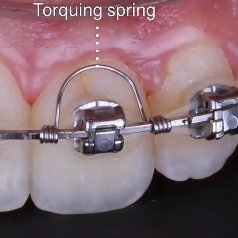 Orthodontic Braces,Dental Orthodontic Bracket Positioning Gauge Type 3