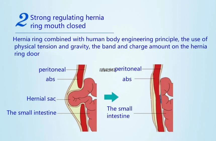 Детская дышащая медицинская детская грыжа с мелким кишечный газовый медицинский мешок паховая грыжа