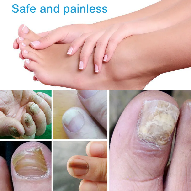 3 мл жидкость для лечения грибка ногтей против грибка пальцев ног Уход за ногтями- MS