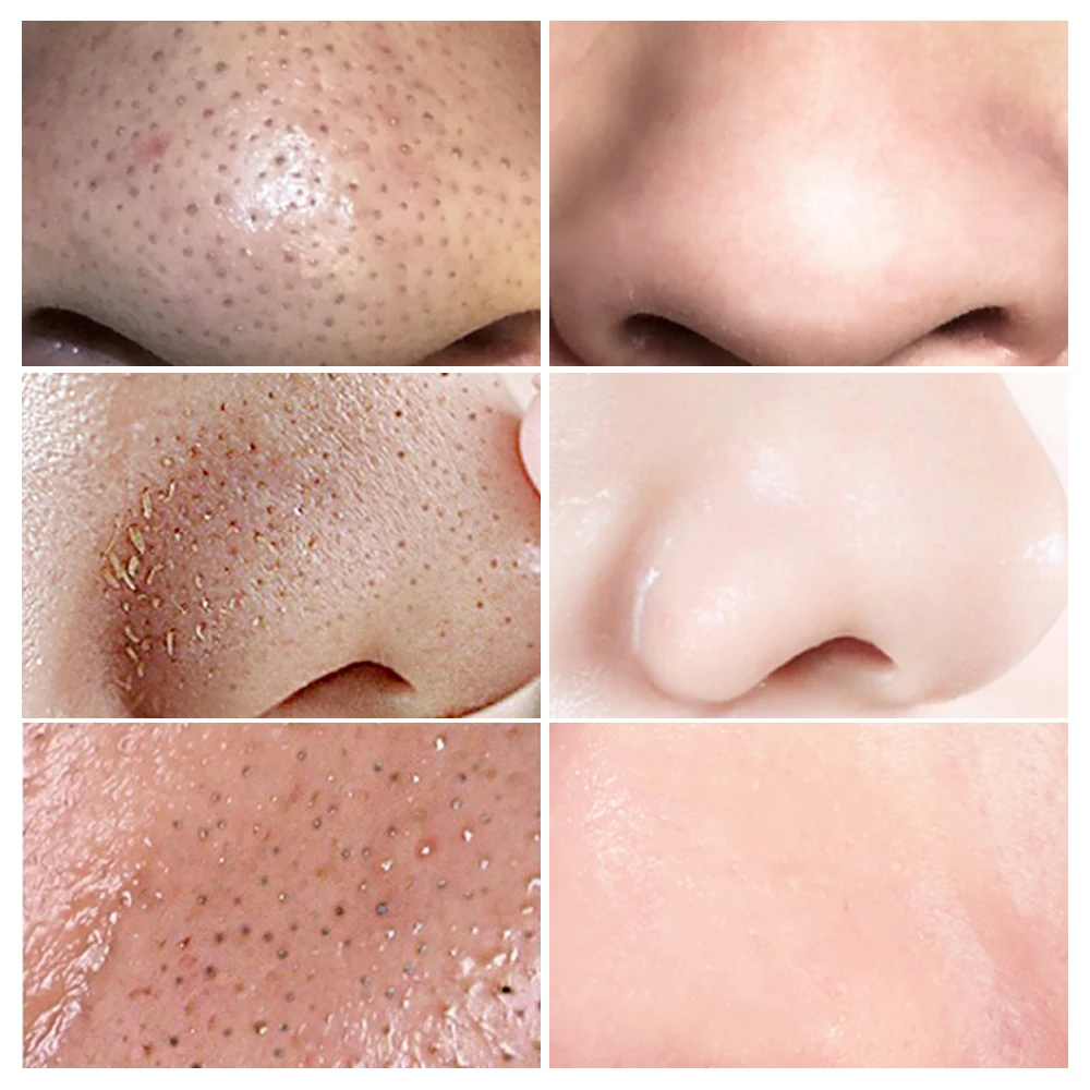 LANBENA Beauty Skin Care Blackhead Remover Mask Serum Deep Cleaning Shrink Pores Purifying Acne Treatment Essence 3