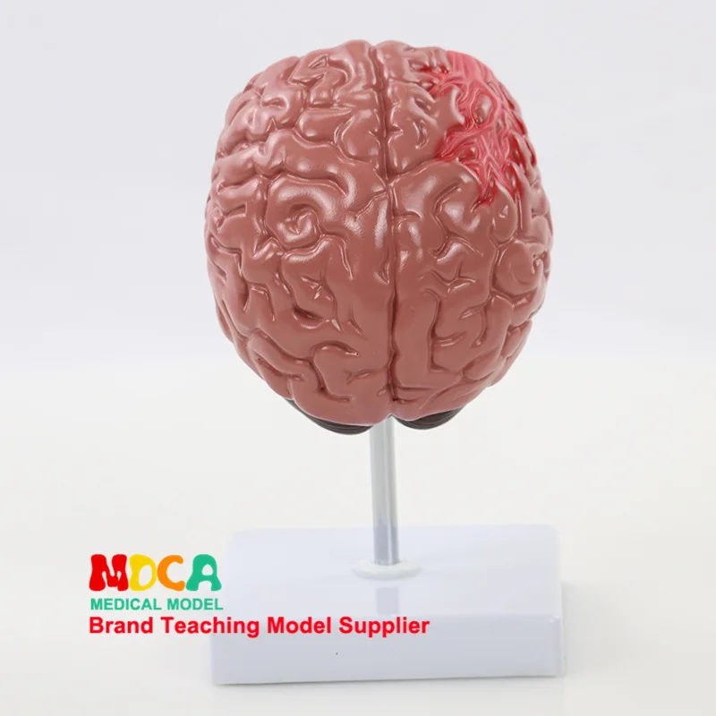

Human Pathology Brain Cerebrovascular Elderly People Brain Model Medicine Teaching Mdn008