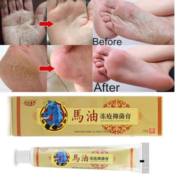 

Horse Oil Feet Cream Care Itch Blisters Peeling Bad Feet Chilblains Ointment Отбеливающий Крем Крем От Псориаза Псориаз Lotion