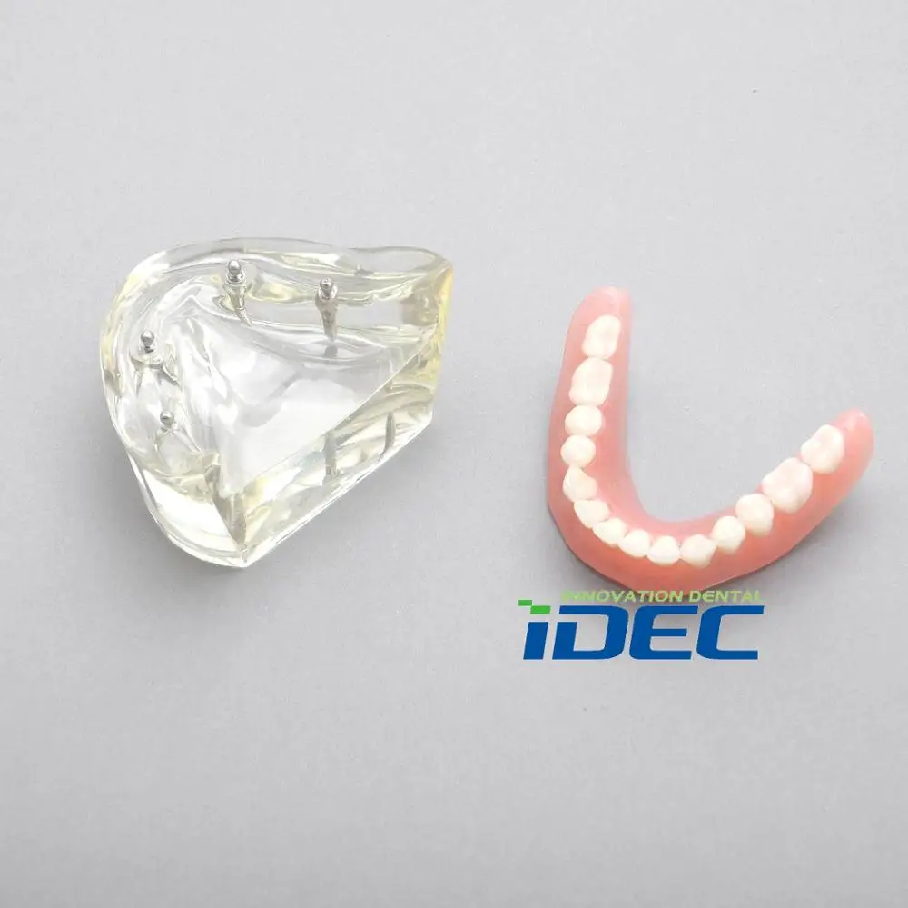 

Dental Model Removable Overdenture Inferior with 4 Implants Demo Model #6002