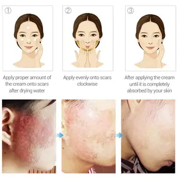 

Nuobisong Face Skin Care Treatment Face Pimples Scar Marks Removal Treatment Whitening Acne Stretch Cream Moisturizing R7U9