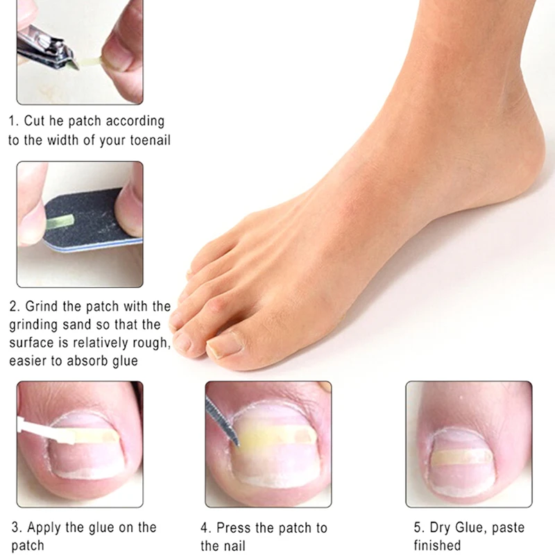 

1 Set Toenail Straightening Clip Curved Brace Toe Nail Ingrown Toenail Patch Pusher Recover Straightening Clip Foot Care