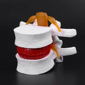 

Human Anatomical Lumbar Disc Herniation Model Medical Learn Aid Anatomy Instrume