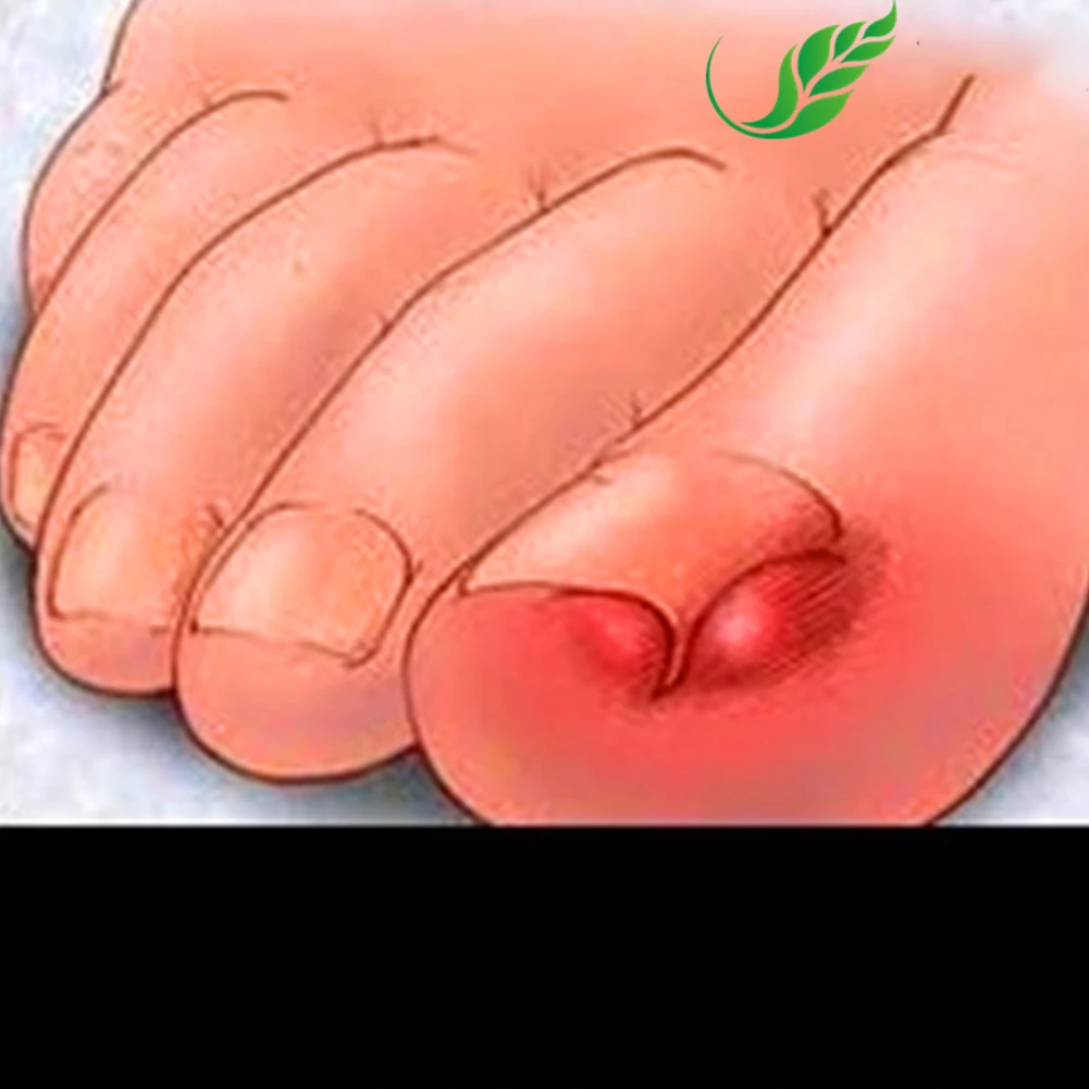 Кожный онихомикоз упрочнение портативный безболезненная инфекция лечение пальцев ног грибок для ногтей Agentia утолщение паронихиа мазь набор