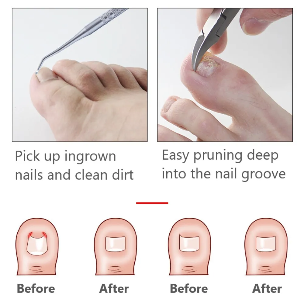 Toe Nail Clippers Nail Correction Thick Nails Ingrown Toenails Nippers Cutters Dead Skin Dirt Remover Pedicure Care Tool