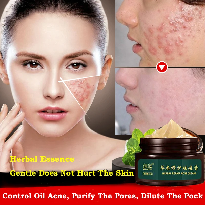 herbal pimple cream
