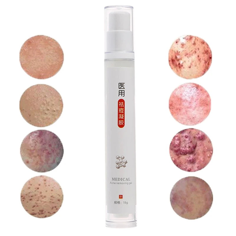 15ML Face Acne Treatment Repair Acne Scars Cream Anti Acne Removal Gel Skin Corrector Care