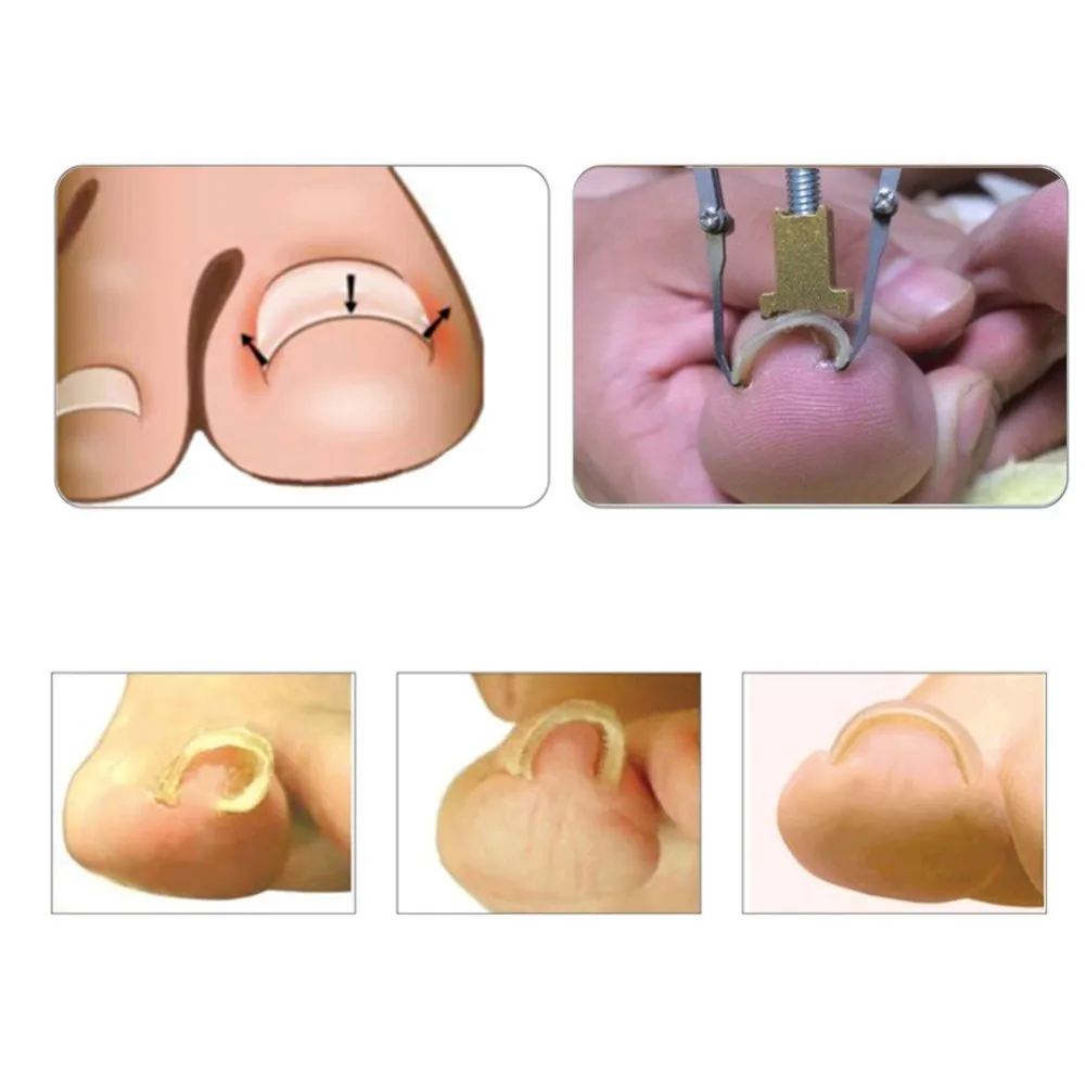 2 шт. для вросших ногтей, педикюра Уход за ногтями на ногах инструмент пилка для ног ортодический акрокс от вросших ноготей Onyxis Bunion корректор для пальцев ног